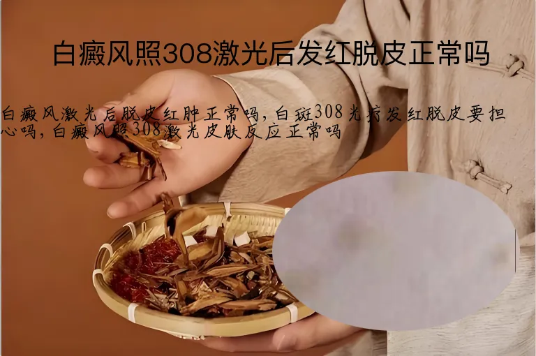 白癜风照308激光后发红脱皮正常吗