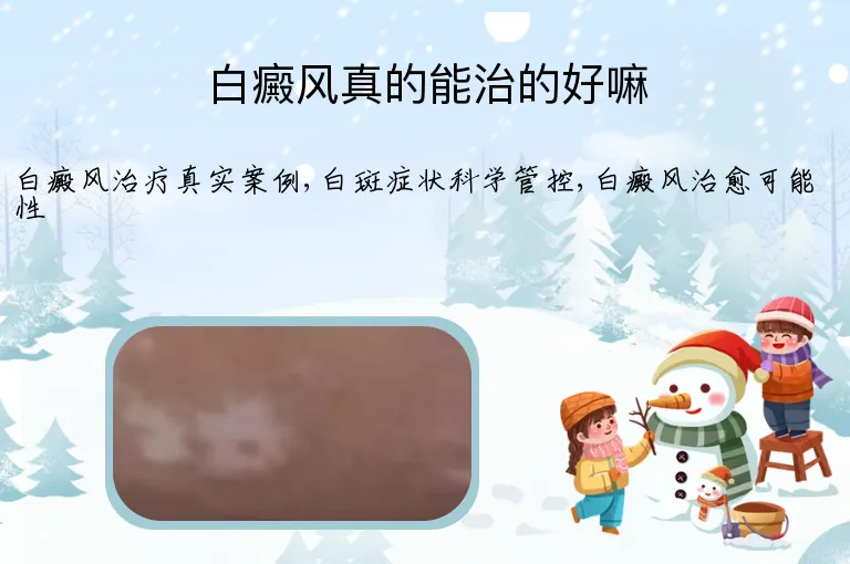 白癜风真的能治的好嘛