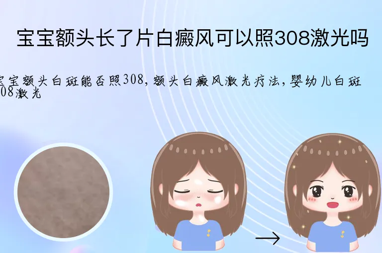 宝宝额头长了片白癜风可以照308激光吗