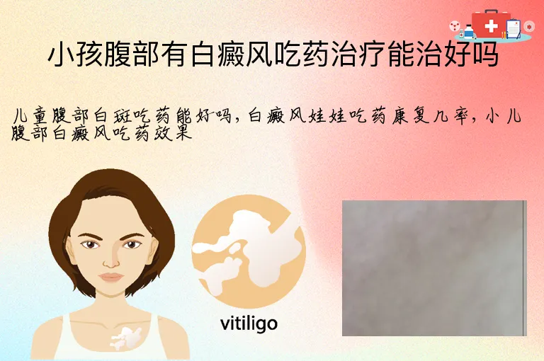 小孩腹部有白癜风吃药治疗能治好吗