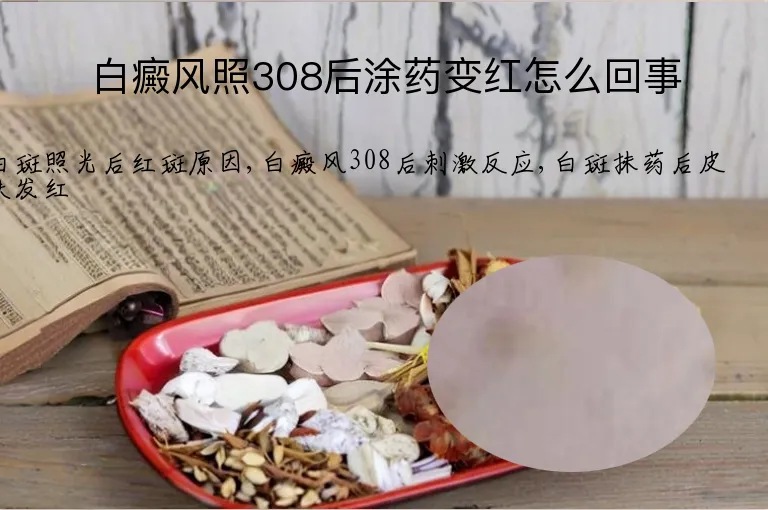 白癜风照308后涂药变红怎么回事