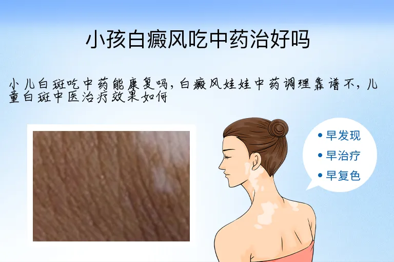 小孩白癜风吃中药治好吗