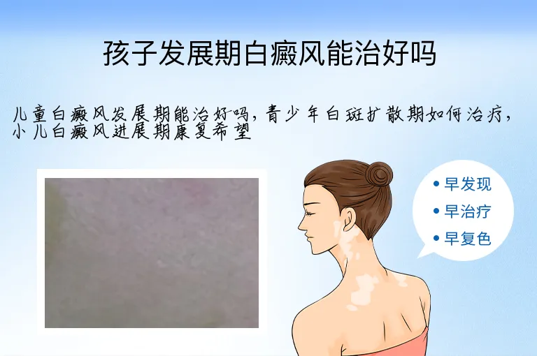 孩子发展期白癜风能治好吗