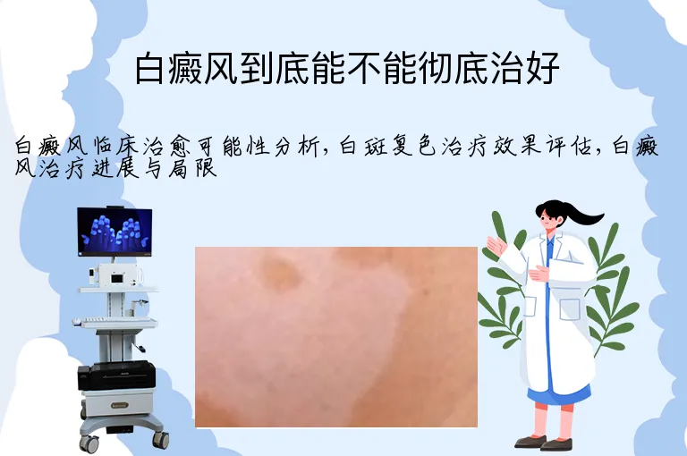 白癜风到底能不能彻底治好
