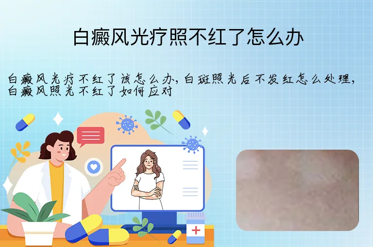 白癜风光疗照不红了怎么办