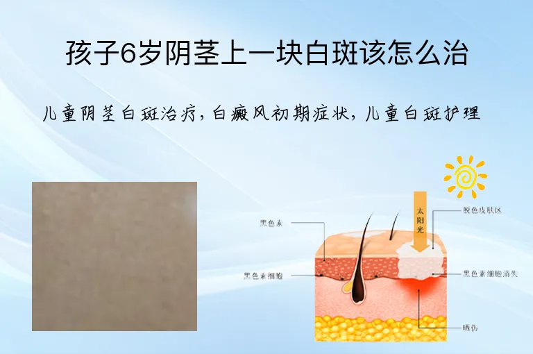 孩子6岁阴茎上一块白斑该怎么治