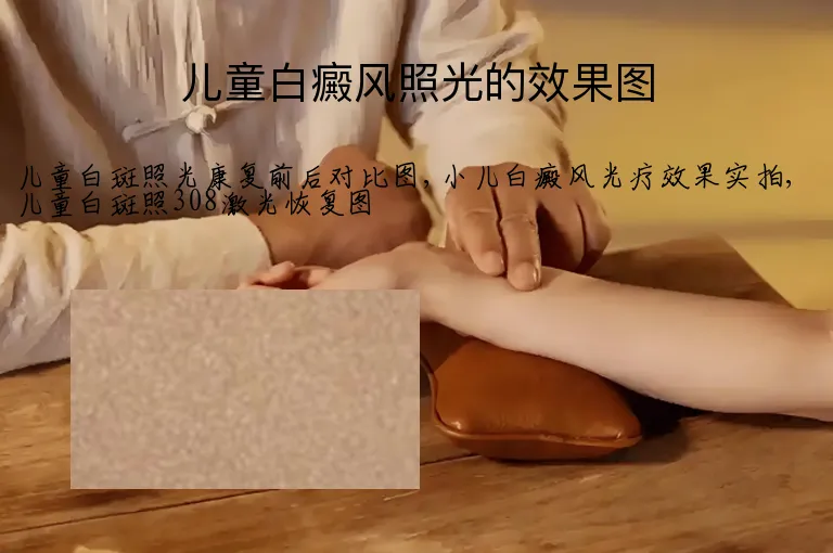 儿童白癜风照光的效果图