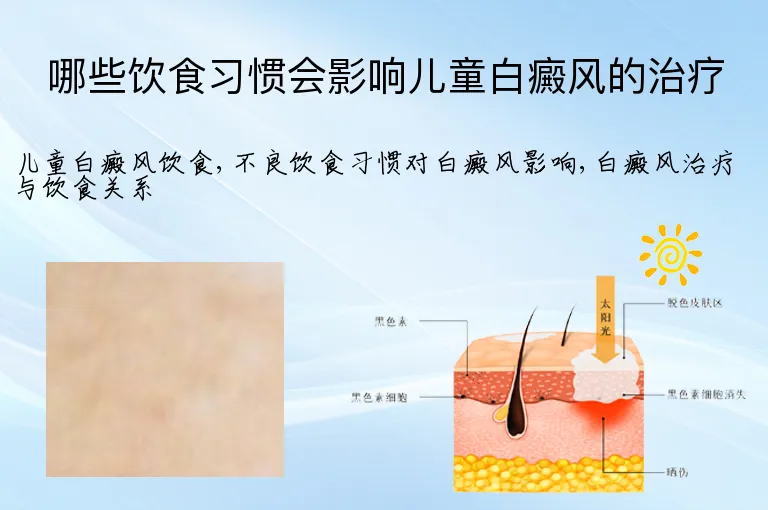 哪些饮食习惯会影响儿童白癜风的治疗