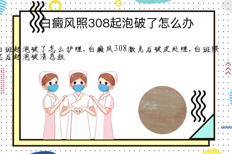 白癜风照308起泡破了怎么办