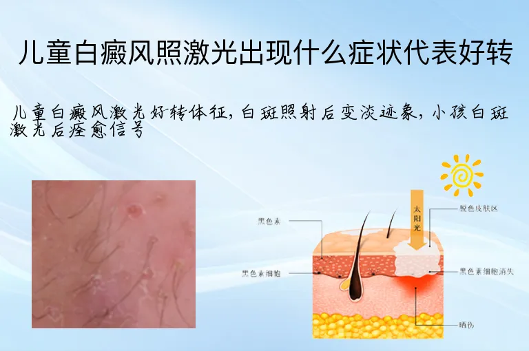 儿童白癜风照激光出现什么症状代表好转