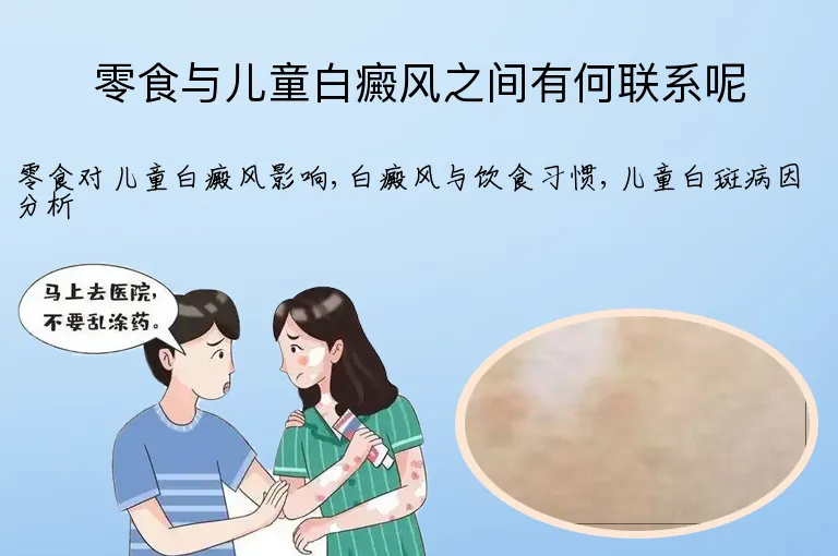 零食与儿童白癜风之间有何联系呢