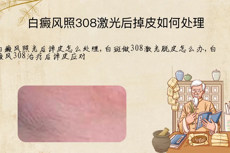 白癜风照308激光后掉皮如何处理