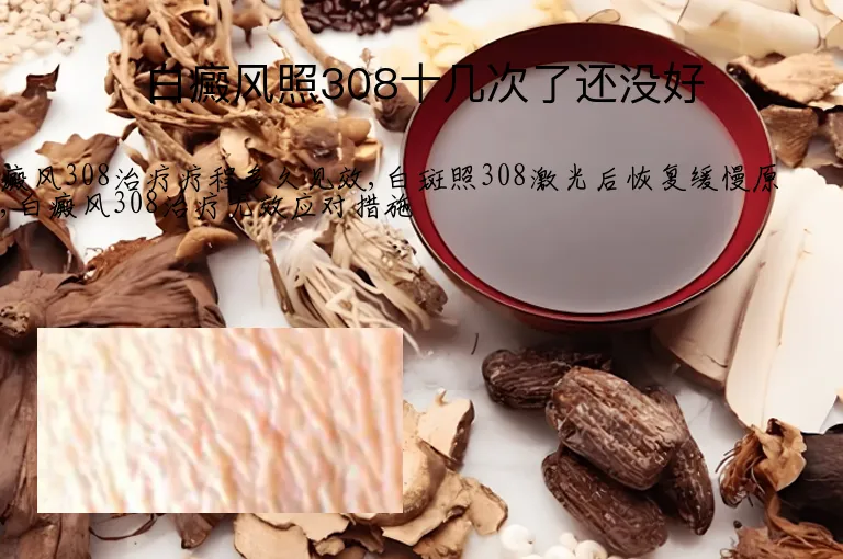 白癜风照308十几次了还没好