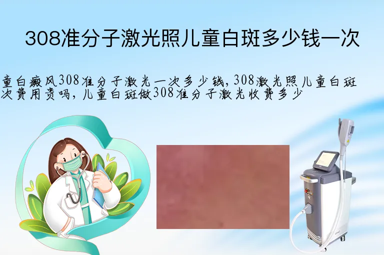 308准分子激光照儿童白斑多少钱一次