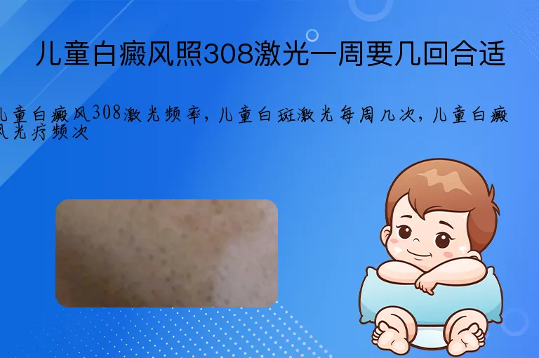 儿童白癜风照308激光一周要几回合适