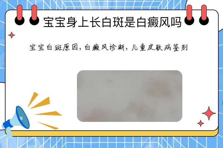 宝宝身上长白斑是白癜风吗