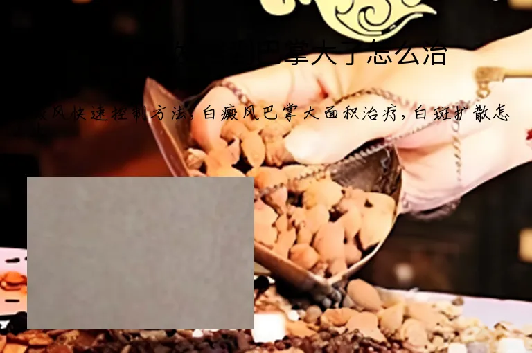 白癜风发展到巴掌大了怎么治