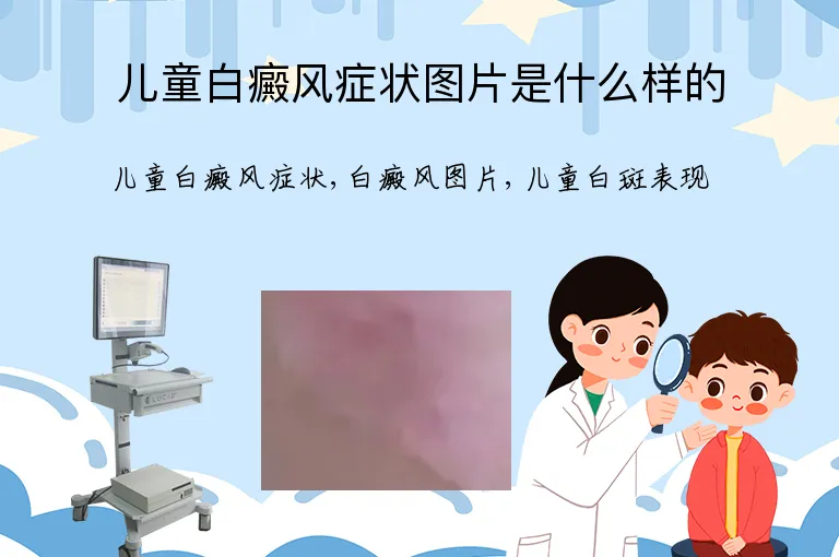 儿童白癜风症状图片是什么样的
