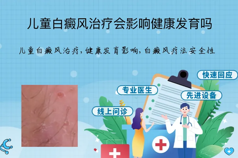 儿童白癜风治疗会影响健康发育吗