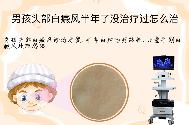 男孩头部白癜风半年了没治疗过怎么治