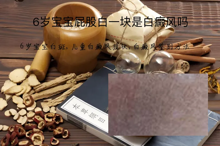 6岁宝宝屁股白一块是白癜风吗