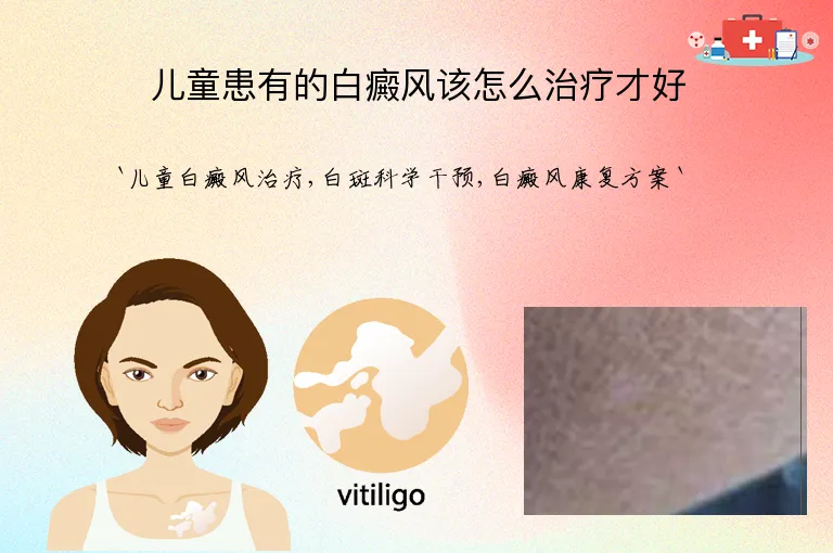 儿童患有的白癜风该怎么治疗才好