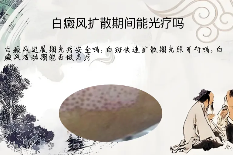 白癜风扩散期间能光疗吗