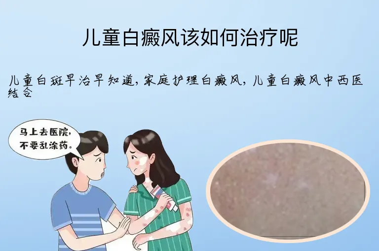 儿童白癜风该如何治疗呢