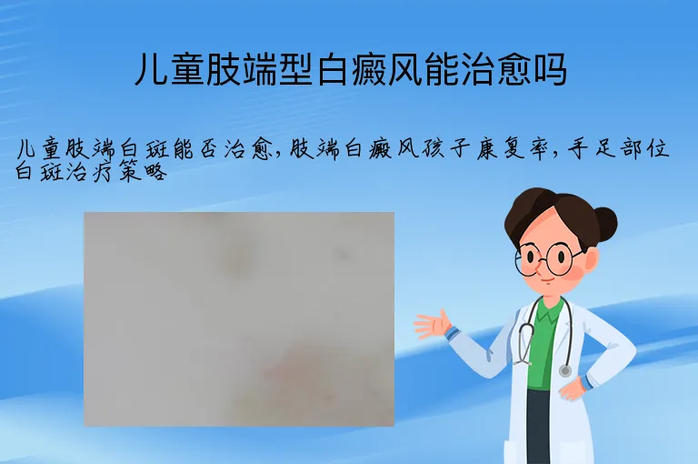 儿童肢端型白癜风能治愈吗
