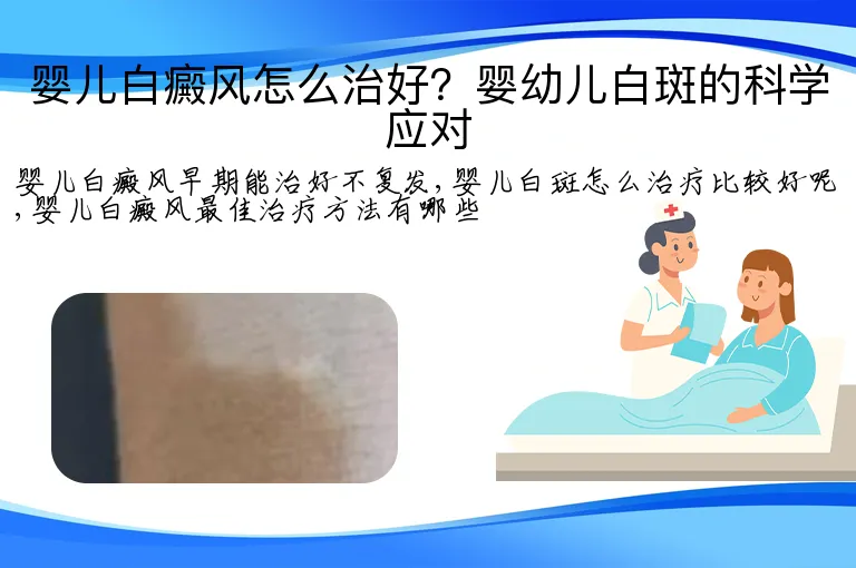 婴儿白癜风怎么治好?婴幼儿白斑的科学应对