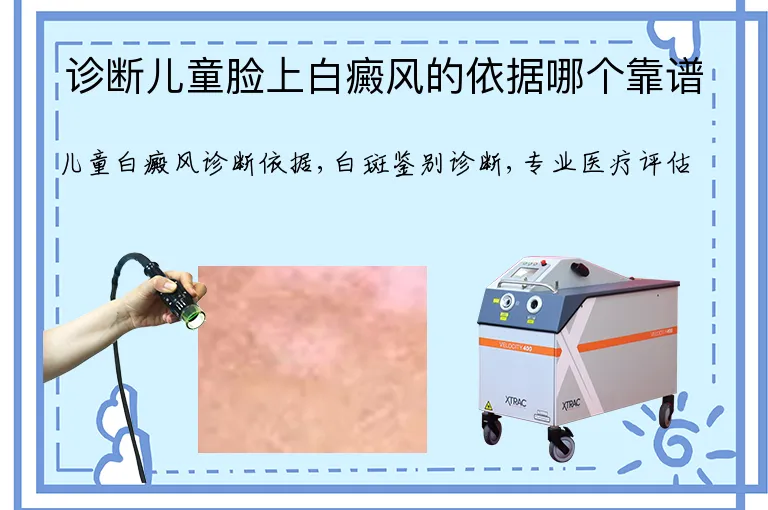 诊断儿童脸上白癜风的依据哪个靠谱