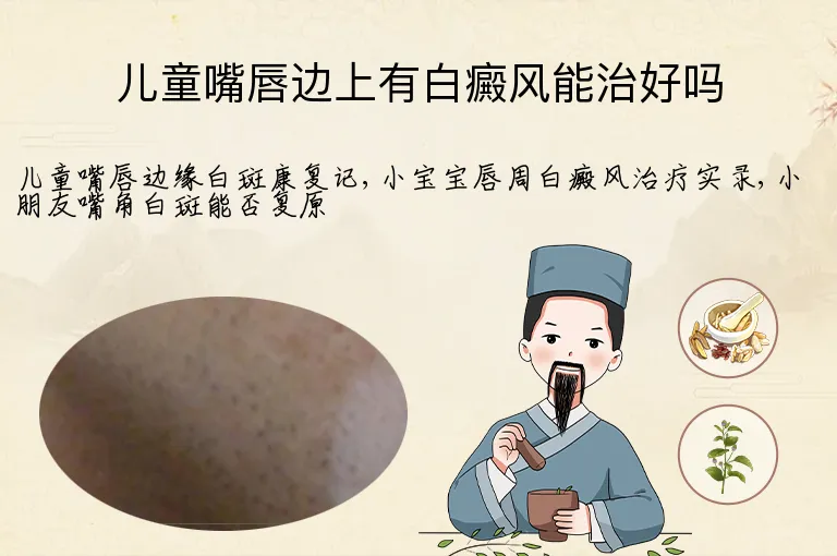 儿童嘴唇边上有白癜风能治好吗