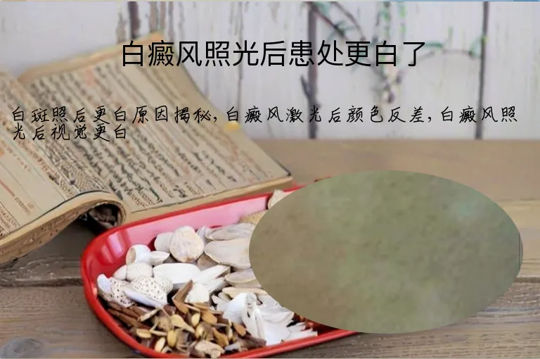 白癜风照光后患处更白了
