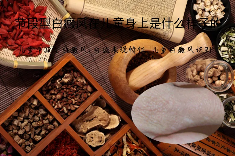 节段型白癜风在儿童身上是什么样子的