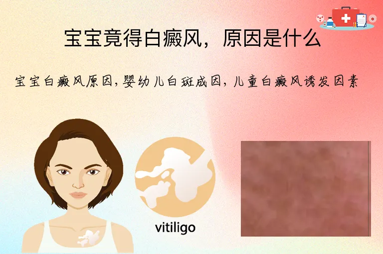 宝宝竟得白癜风，原因是什么
