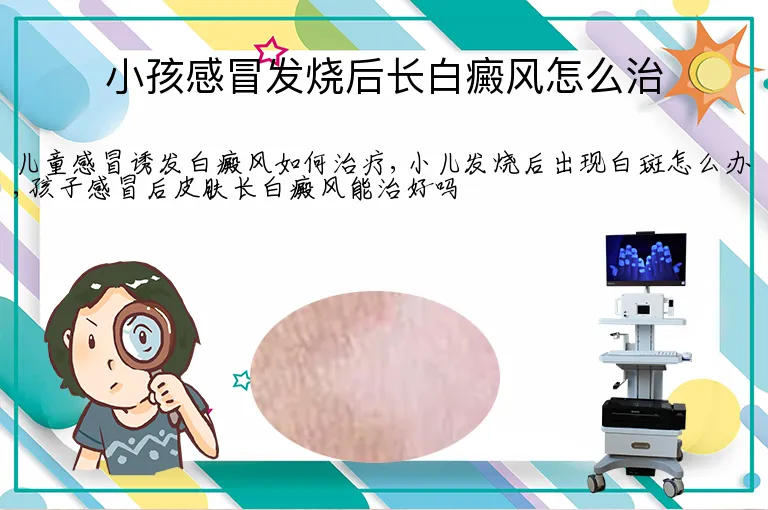 小孩感冒发烧后长白癜风怎么治