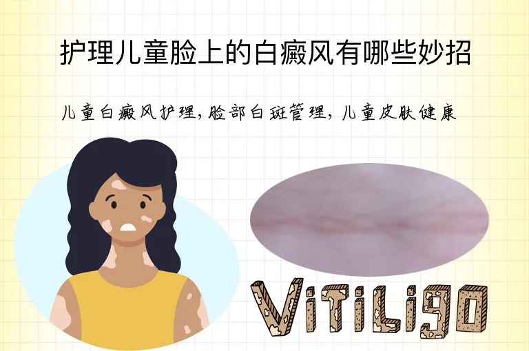 护理儿童脸上的白癜风有哪些妙招