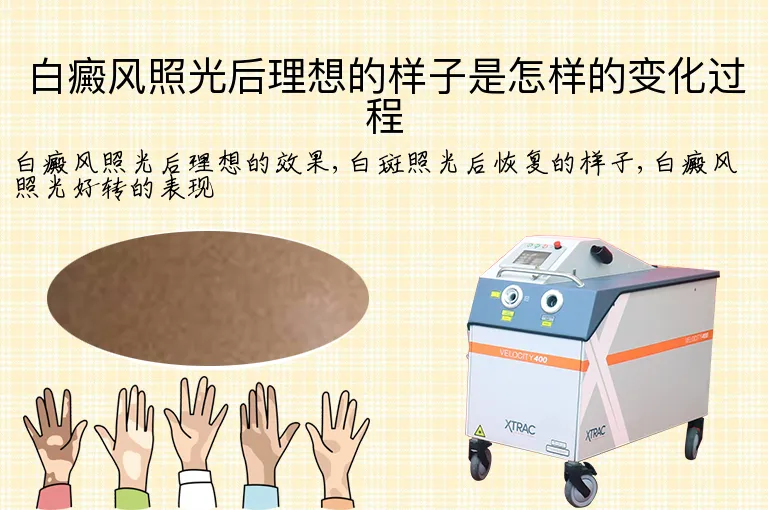 白癜风照光后理想的样子是怎样的变化过程