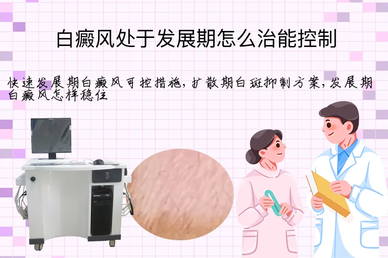 白癜风处于发展期怎么治能控制