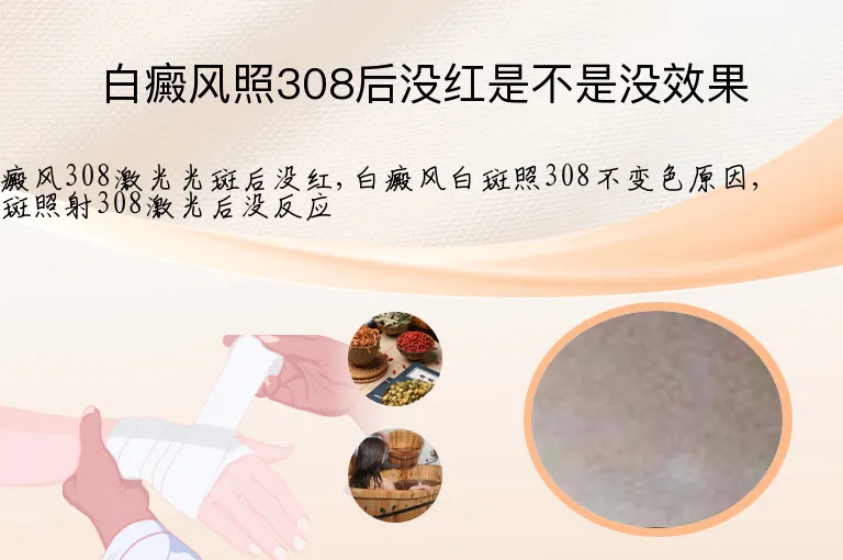 白癜风照308后没红是不是没效果