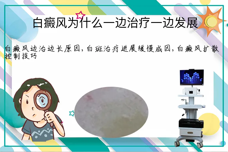 白癜风为什么一边治疗一边发展