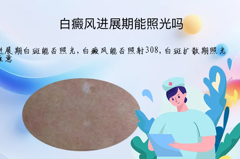 白癜风进展期能照光吗
