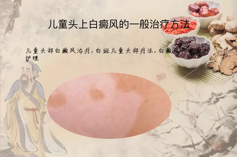 儿童头上白癜风的一般治疗方法