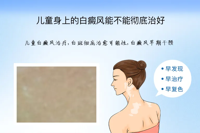 儿童身上的白癜风能不能彻底治好
