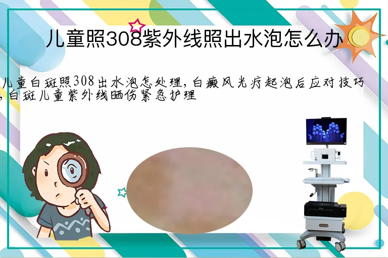 儿童照308紫外线照出水泡怎么办