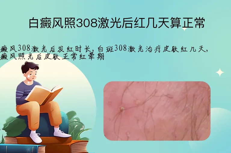 白癜风照308激光后红几天算正常
