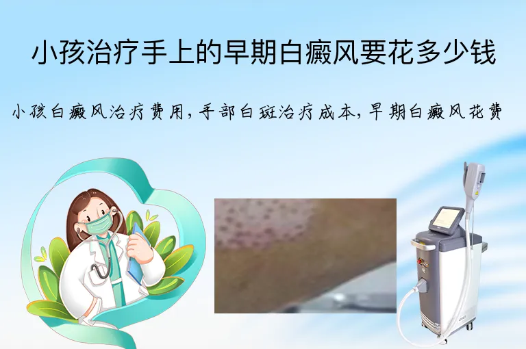 小孩治疗手上的早期白癜风要花多少钱