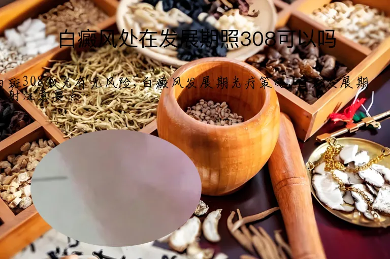 白癜风处在发展期照308可以吗