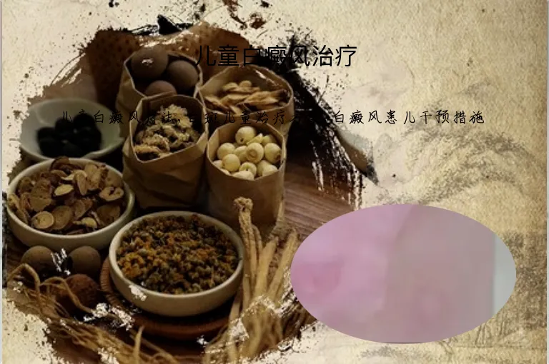 儿童白癜风治疗