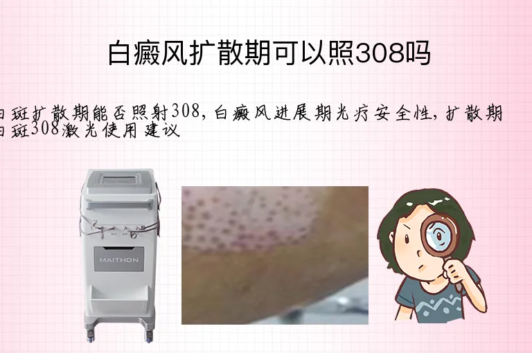 白癜风扩散期可以照308吗